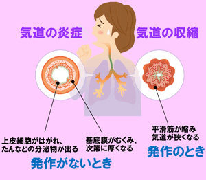 ぜんそく患者さんの気道の断面