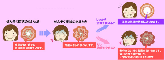 ぜんそく治療の方法　1990年代以降