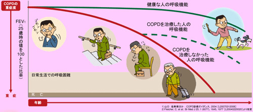 COPDを治療しないとどうなるの?